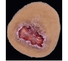 CS-008_Venous_Wound_Dark