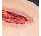 ClinincalWound_dehisence2_web-SQ