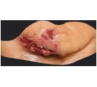 006_JawLaceration_MediumSkinTone