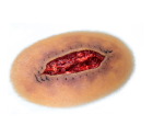 CS014-ClinicalWound_dehiscenceMedium