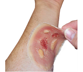 ThermalBurn_med_SW010_9d125731-b187-4170-b82f-7e59cccdee63_1800x18002