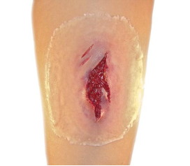 LacerationMedium_1800x18002