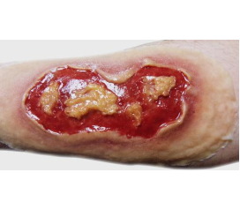 ElectricalBurnMedium_1800x18001