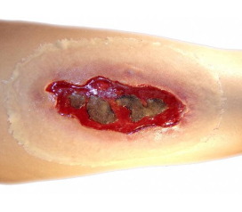 ElectricalBurnLARGE2_1800x18002