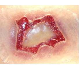 ChemicalBurnMedium_1800x1800