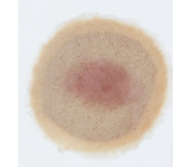 ST-1_PressureInjury_Lt