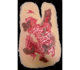 SW017_3degreeARM_debrided