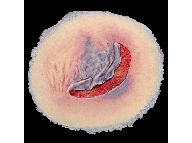 CS009_ClinicalWound_1SkinTearLT