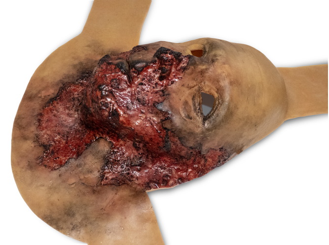 011_BurnFace_mediumSkinTone