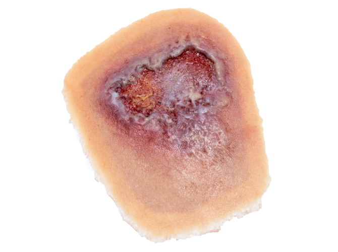 CS-008_Venous_Wound_Medium