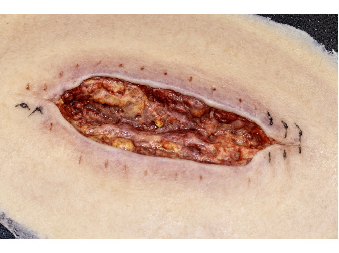 ClinicalWound_stitches-web