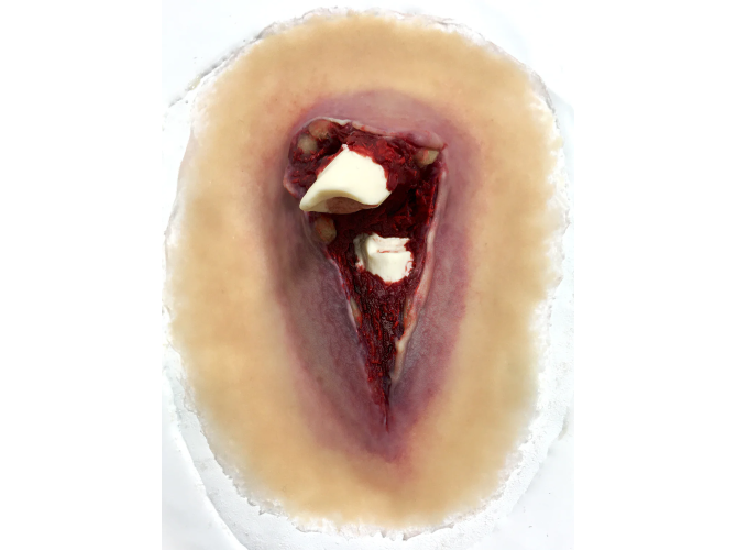 sw013_compound_fracture_1800x1800