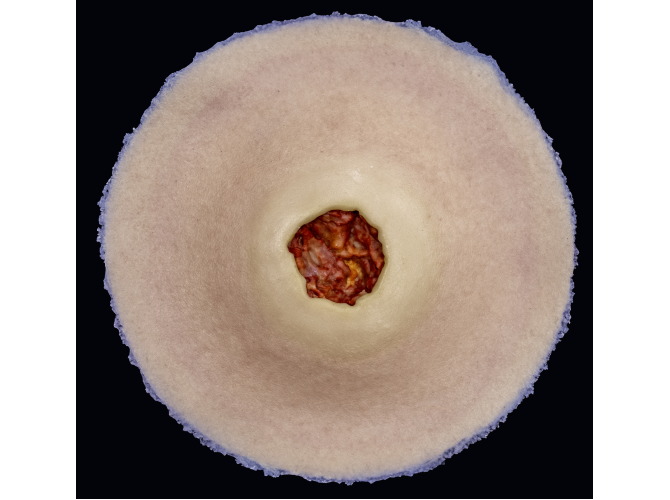 CS-009_DiabeticUlcer_Light