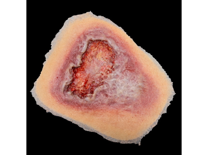 CS-008_Venous_Wound_Med