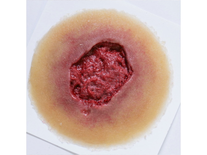 Infection-SelfAdhesive-MED