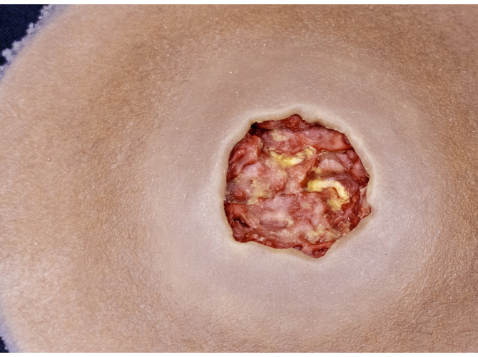 CS-009_DiabeticUlcerCloseUp_Dark