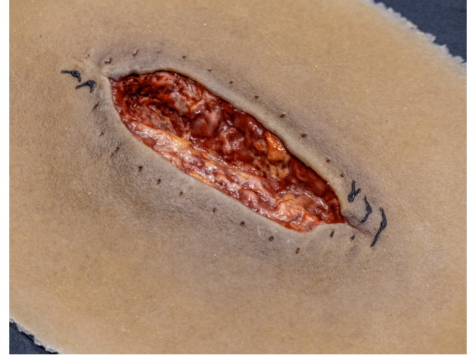 CS014-surgical-Dehiscence_DarkClose