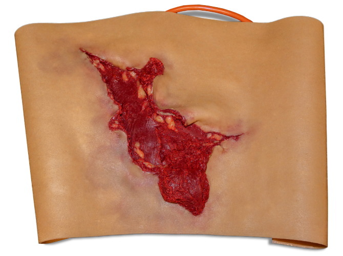 009_calf_Avulsion_MediumTone