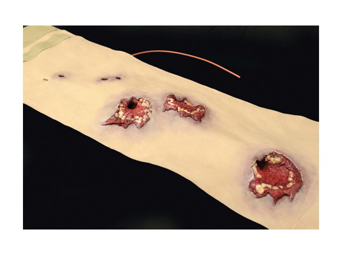 901_GSW_Abdomen_Light1