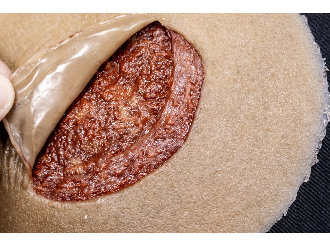 CS011Clinical_Sticky_SkinTear-FLAP_Dark2Web