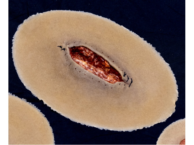 CS014-surgicalDehiscence_Dark