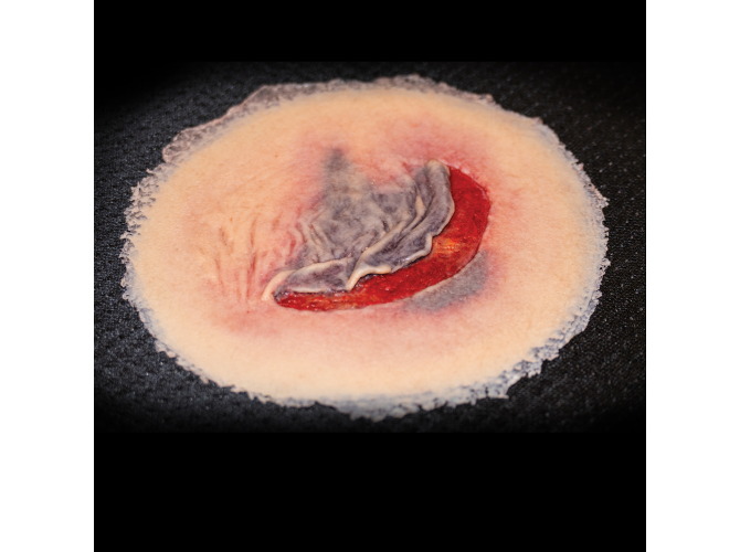 CS009_ClinicalWound_1SkinTear