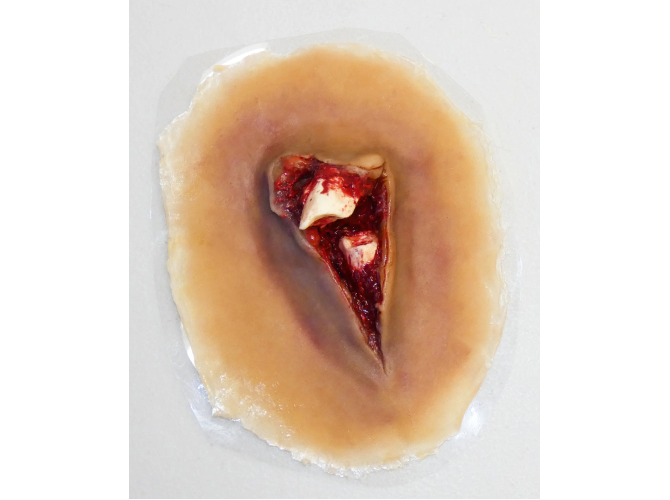 SW013_CompoundFracture_MediumSkin_1800x18005