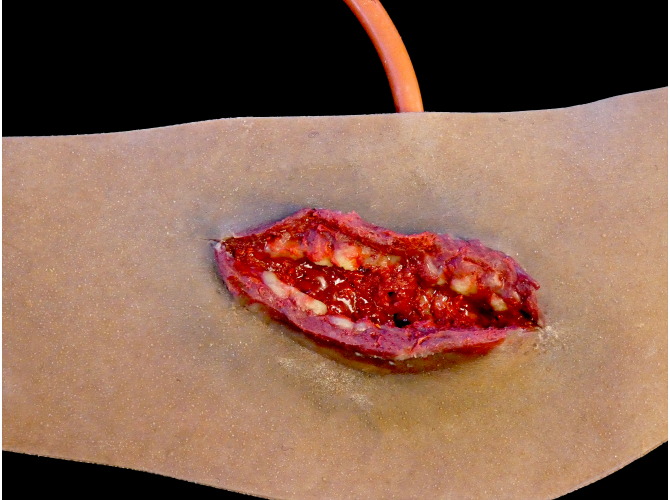 014_Neck_Laceration_Dark_