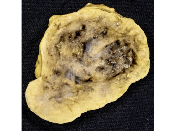 CTS-UP4_unstageable_PLUG_forST4