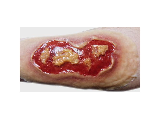 ElectricalBurnMedium_1800x18001