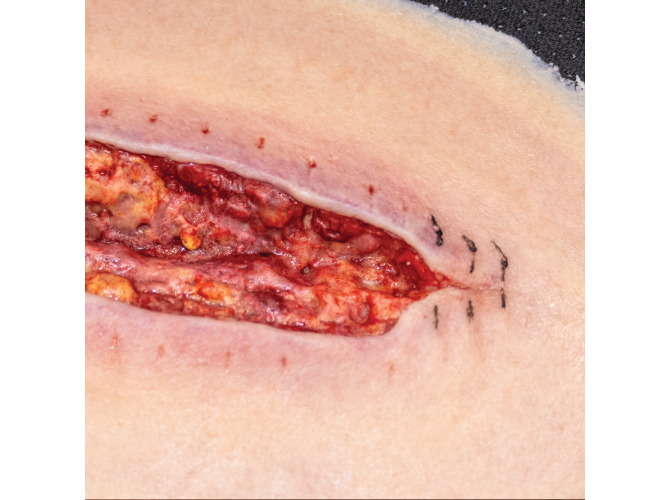 ClinincalWound_dehisence2_web-SQ