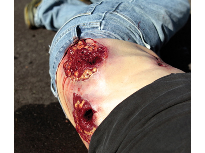 901_GSW_Abdomen_Light