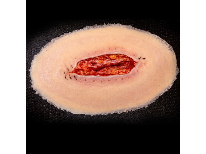 CS014-ClinicalWound_dehiscence_LT