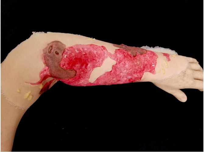 SW017_3degreeARM_debrided_2