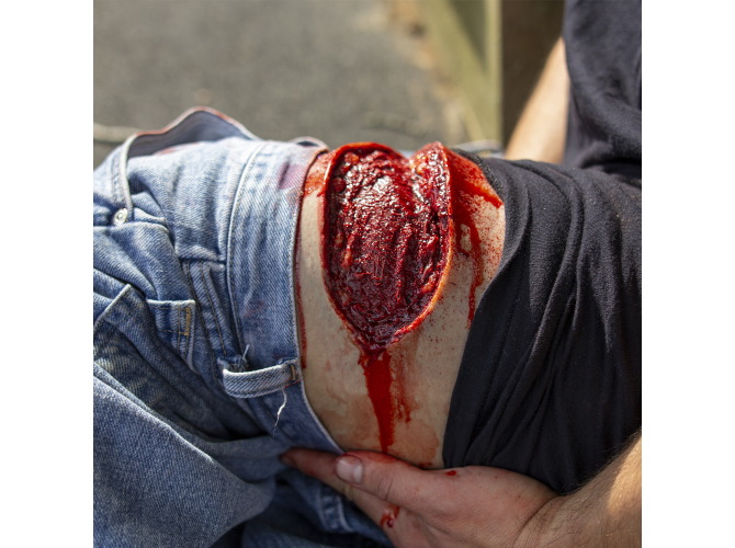 001_ThighLaceration1