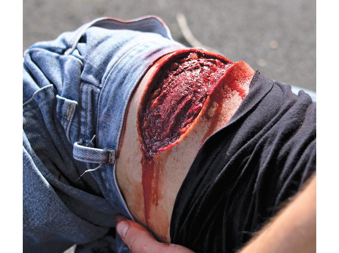 001_ThighLacerationLT_2