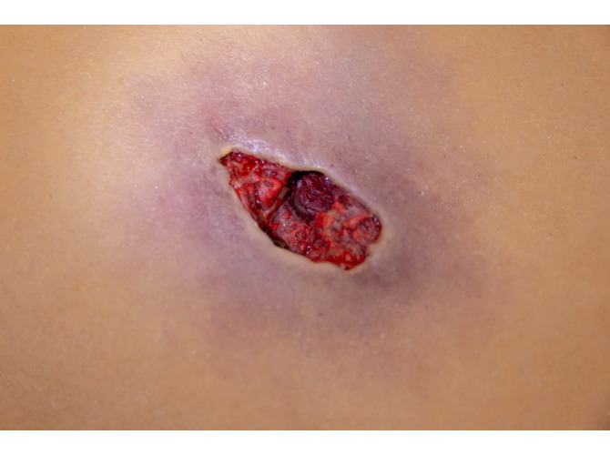 CTS-012Wound-Tunnel_Close2_1800x1800