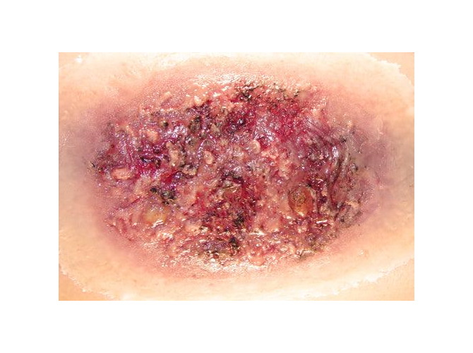 Thermal-Burn-Large_2_1800x1800