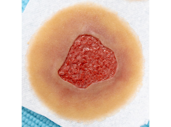 Granulation_SelfAdhesiveMED