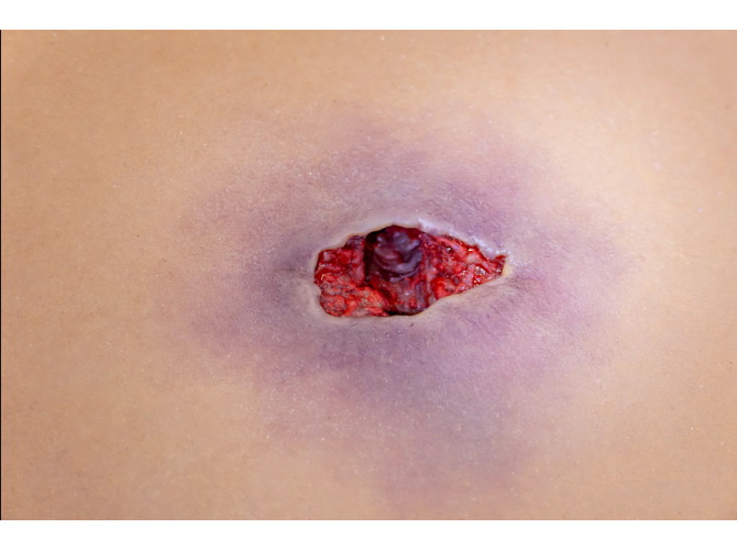 CTS-012Wound-Tunnel_Close_1800x1800