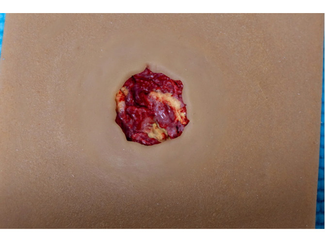 CTS_009_DiabeticUlcer_Dark_1800x1800