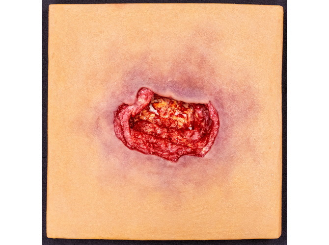 CTS-004_ST4_Pressure_Injury_MED_1800x1800