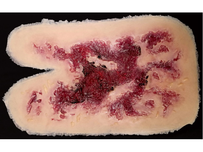 SW016_3rd_Degree_ThermalarmBurn