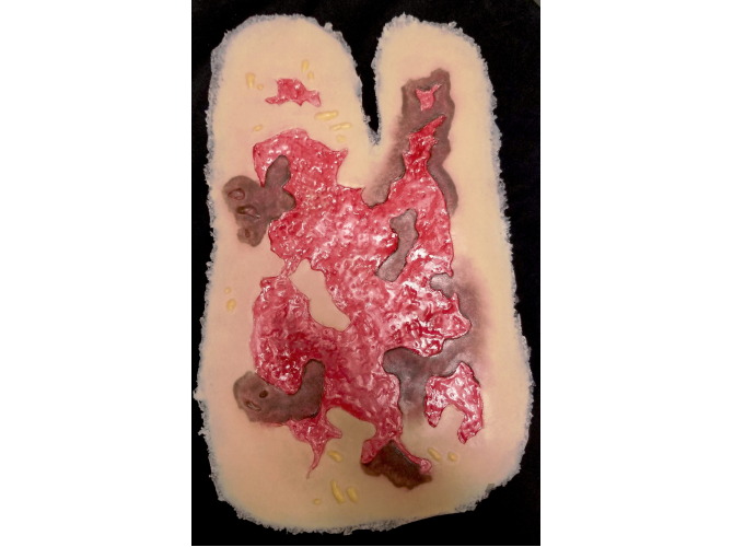 SW017_3degreeARM_debrided