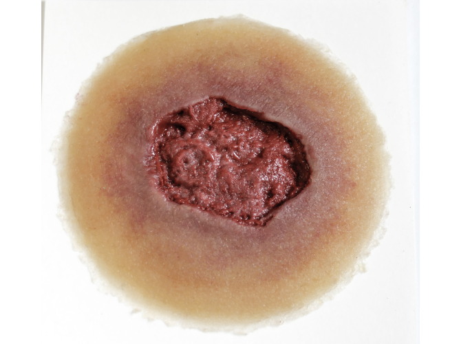 Infection_SelfAdhesive_med2