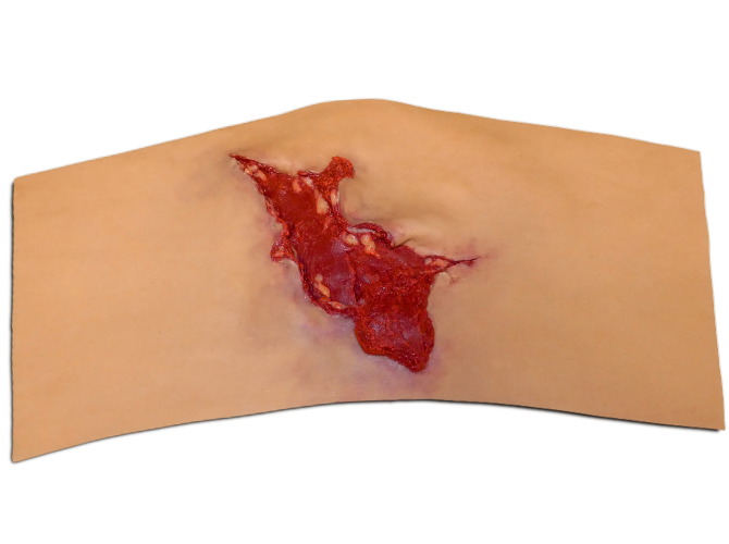 009_calf_Avulsion_MediumTone1