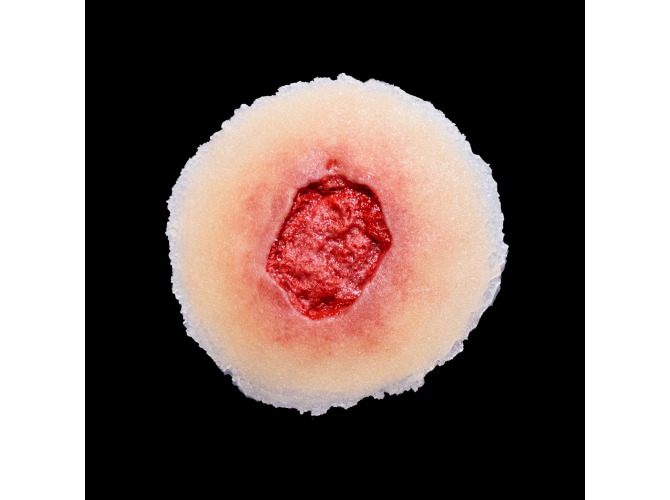 Infection-SelfAdhesive-LT-2