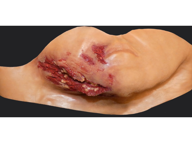 006_JawLaceration_MediumSkinTone