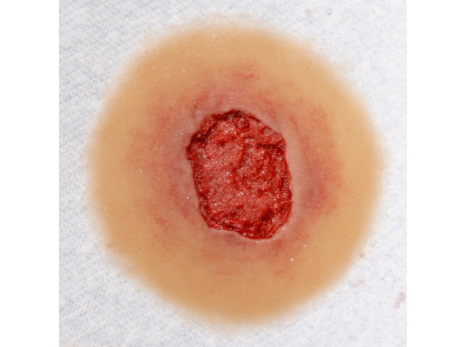 Infection_SelfAdhesive_med