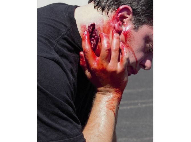 014_Neck_Laceration_2